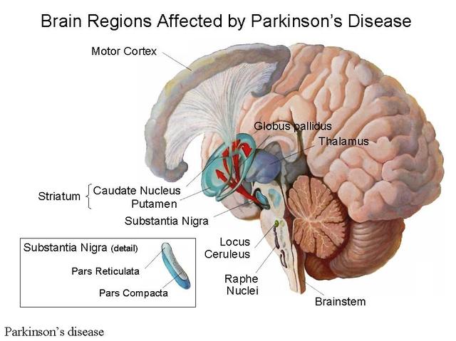 Parkinsons-Disease