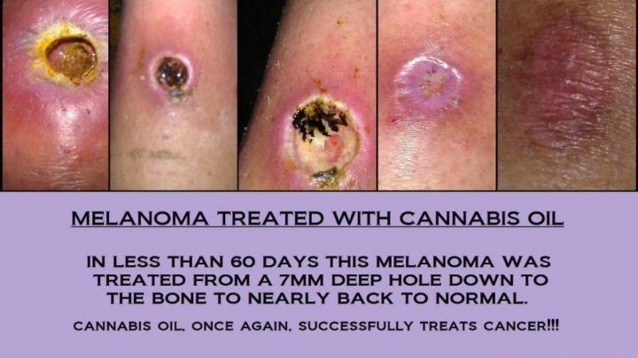 Een beetje een ranzig beeld, maar opnieuw bewijs dat cannabis(olie) tot onvoorstelbare genezing leidt